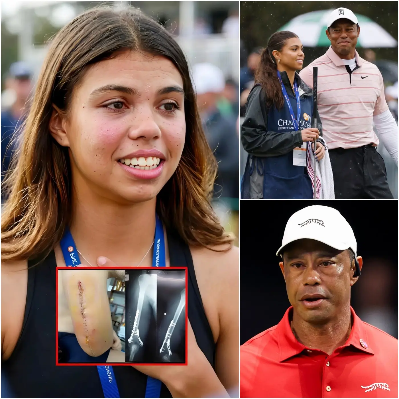 Cover Image for 💔SAD NEWS: Sam Alexis Woods – daughter of golf legend Tiger Woods – has left the world stunned after posting a deeply emotional message revealing that her father’s critical leg surgery took a devastating turn and did not go as planned.